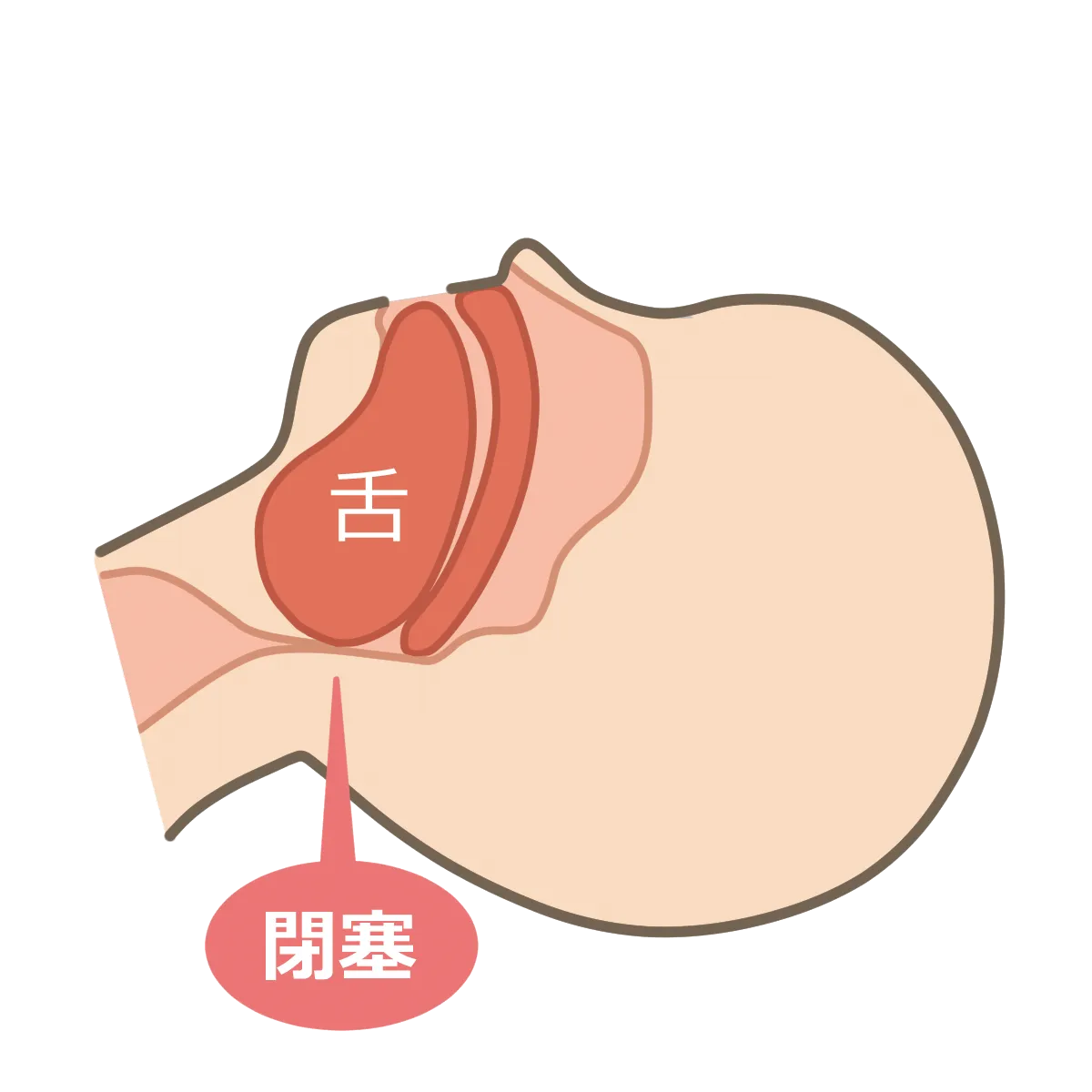 睡眠時無呼吸症候群の気道